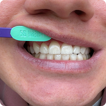 SENSITIVE ENAMEL